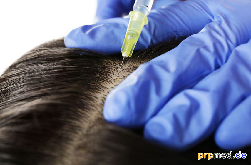 Inyección de PRP para el cabello