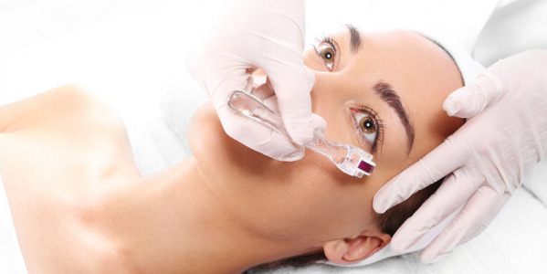 Microneedling for acne scars