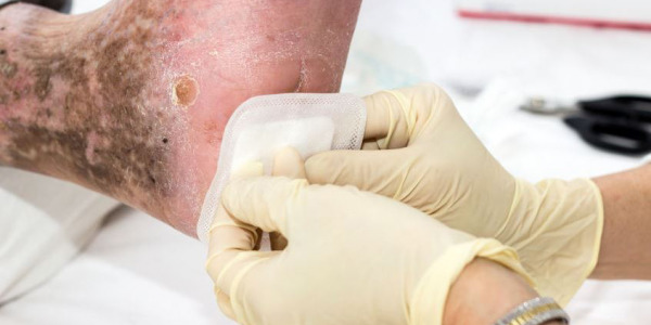 PRP treatment of diabetic foot ulcers and wounds