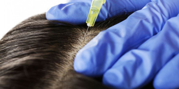 PRP tedavisi saç dökülmesinde işe yarar mı?