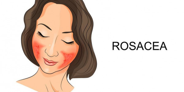 Mit PRP Behandlung gegen Rosazea