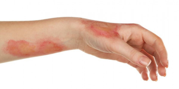 Terapia PRP per le cicatrici delle ferite
