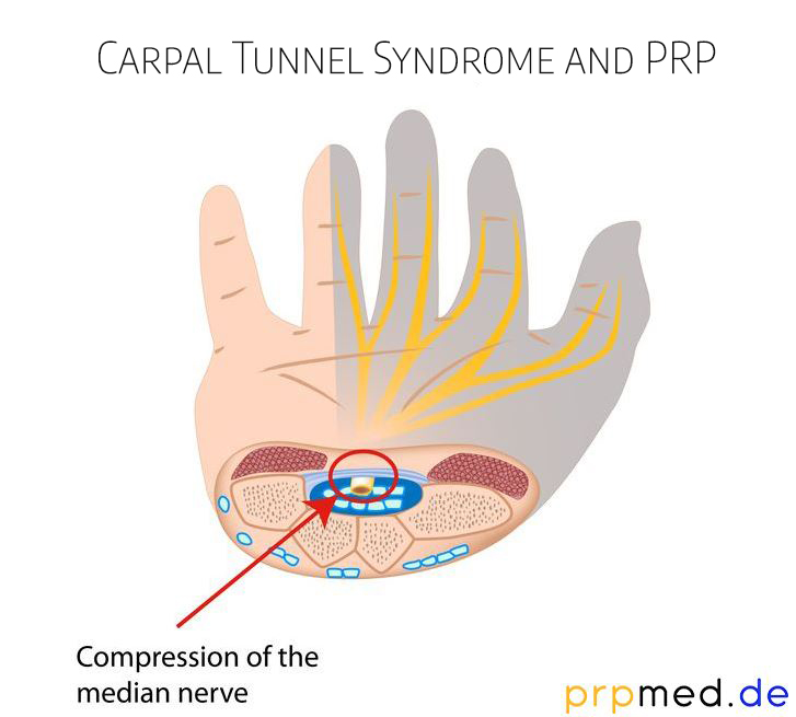 Kann Karpaltunnelsyndrom mit PRP-Therapie behandelt werden?