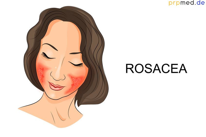 Rosacea'ya karşı PRP tedavisi ile
